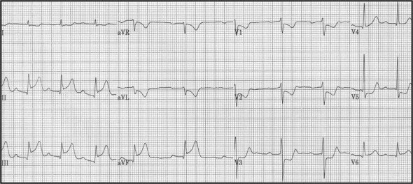 84_Acute inf STEMI