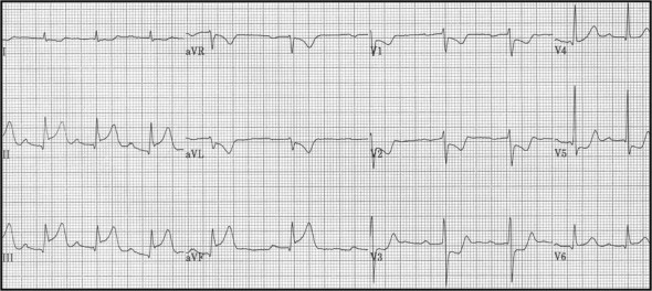 84_Acute inf STEMI