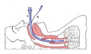 ET_tube_x_section