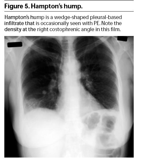 Hampton's hump Emergency Medicine Practice