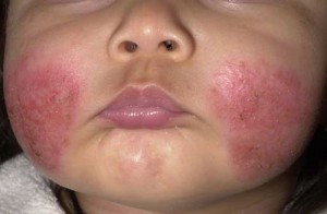 atopic_dermatitis_acute