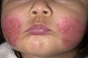 atopic_dermatitis_acute