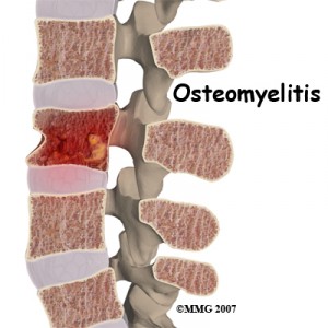 child_back_pain_osteomyelitis