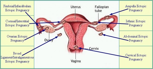 ectopicpregnancydiagramcomplete