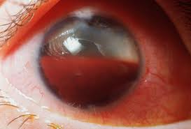 hyphema