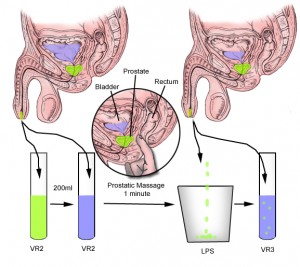 prostatic massage