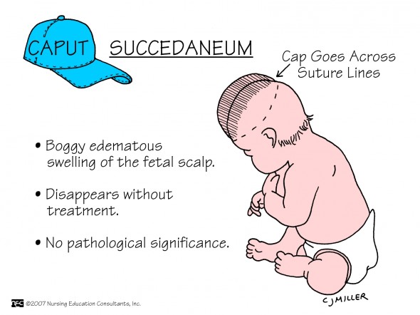 Caput Succedaneum