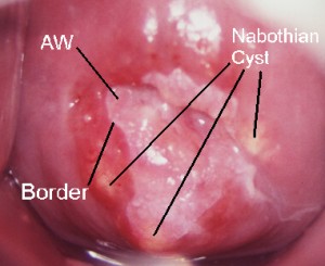 Nabothian-cyst