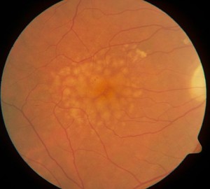 460pxMacularSoftDrusen 1 | The Physician Assistant Life 460px Macular Soft Drusen 1