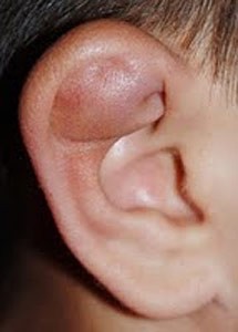 AuricularHematoma | The Physician Assistant Life Auricular Hematoma