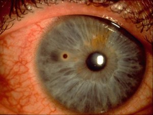 CornealFBRustRing | The Physician Assistant Life CornealFBRustRing
