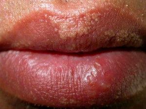fordycespotsonlipspictures4 | The Physician Assistant Life fordyce spots on lips pictures 4