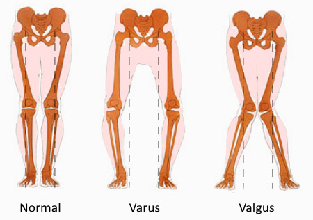 normalvarusvalgus | The Physician Assistant Life normal varus valgus